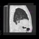 Bronchopneumonia, pleural effusion: CT - Computed tomography