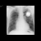 Bullous emphysema: X-ray - Plain radiograph
