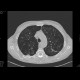 Bullous emphysema: CT - Computed tomography