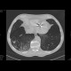 Bullous emphysema: CT - Computed tomography