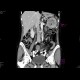 Carcinoma of the lienal flexure: CT - Computed tomography