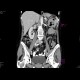 Carcinoma of the lienal flexure: CT - Computed tomography