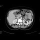 Carcinoma of the lienal flexure: CT - Computed tomography
