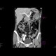 Carcinoma of the lienal flexure: CT - Computed tomography