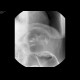 Carcinoma of the lienal flexure: RF - Fluoroscopy