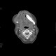 Carcinoma of the mouth floor and tongue: CT - Computed tomography