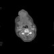 Carcinoma of the mouth floor and tongue: CT - Computed tomography
