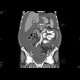 Pancreatic carcinoma, carcinomatous peritonitis, ascites: CT - Computed tomography