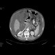 Pancreatic carcinoma, carcinomatous peritonitis, ascites: CT - Computed tomography