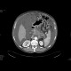 Pancreatic carcinoma, carcinomatous peritonitis, ascites: CT - Computed tomography