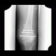 Callus luxurians, callus, hypetrophic callus: X-ray - Plain radiograph