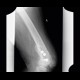Callus luxurians, callus, hypetrophic callus: X-ray - Plain radiograph