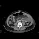Caput medusae, porto-venous shunts, splenomegaly: CT - Computed tomography
