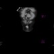 Caput medusae, porto-venous shunts, splenomegaly: CT - Computed tomography