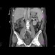 Caput medusae, porto-venous shunts, splenomegaly: CT - Computed tomography