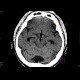 Cisterna cerebellomedullaris permagna: CT - Computed tomography