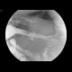 Duodenal diverticulum: RF - Fluoroscopy