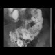 Duodenal diverticulum, large and multiple: RF - Fluoroscopy