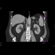 Renal tumour, small: CT - Computed tomography