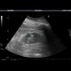 Renal tumour, small: US - Ultrasound