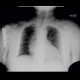 Deviation of trachea: X-ray - Plain radiograph