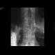 Fibrodysplasia ossificans progressiva: X-ray - Plain radiograph