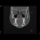 Fibrous dysplasia of the mandible: CT - Computed tomography