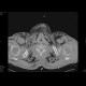 Fluidopneumothorax, pneumomediastinum, subcutaneous emphysema, muscular emphysema, pneumocolum: CT - Computed tomography