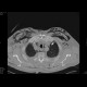 Fluidopneumothorax, pneumomediastinum, subcutaneous emphysema, muscular emphysema, pneumocolum: CT - Computed tomography