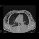 Fluidopneumothorax, pneumomediastinum, subcutaneous emphysema, muscular emphysema, pneumocolum: CT - Computed tomography