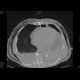 Fluidopneumothorax, pneumomediastinum, subcutaneous emphysema, muscular emphysema, pneumocolum: CT - Computed tomography