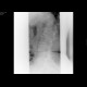 Compression fracture of lumbar vertebra: X-ray - Plain radiograph