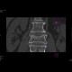 Compression fracture of lumbar vertebra: CT - Computed tomography