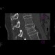 Compression fracture of lumbar vertebra: CT - Computed tomography