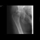 Acetabular fracture, posterior dislocation of the femoral head, dashboad injury: X-ray - Plain radiograph