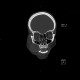 Teardrop figure, orbital floor fracture, blow-out fracture: CT - Computed tomography
