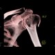 Fracture of humerus, comminuted: CT - Computed tomography