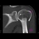 Fracture of humerus, comminuted: CT - Computed tomography