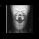 Fracture of the mandible: X-ray - Plain radiograph