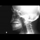 Fracture of the mandible: X-ray - Plain radiograph