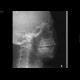 Fracture of the mandible: X-ray - Plain radiograph