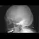 Fracture of dens axis: X-ray - Plain radiograph