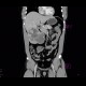 Hemangioma: CT - Computed tomography