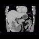 Hemangioma: CT - Computed tomography