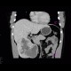 Liver hemangioma, gigantic: CT - Computed tomography