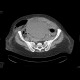Incarcerated hernia, hematoma of abdominal wall: CT - Computed tomography