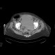 Incarcerated hernia, hematoma of abdominal wall: CT - Computed tomography