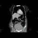 Incarcerated hernia, hematoma of abdominal wall: CT - Computed tomography
