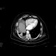 Ileus, pneumoperitoneum, peritonitis: CT - Computed tomography