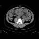 ileus, small bowel obstruction on terminal ileum: CT - Computed tomography